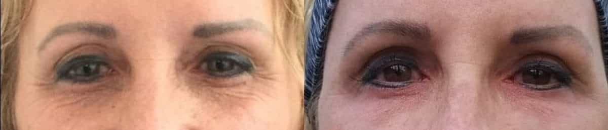 before and after comparison of a womans eyes showing the results of eyelid surgery