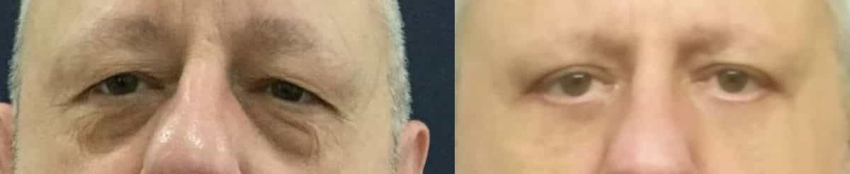 before and after eyelid surgery blepharoplasty on male patient
