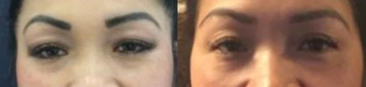 results of eyelid surgery, showing a comparison of the eyes before and after the procedure