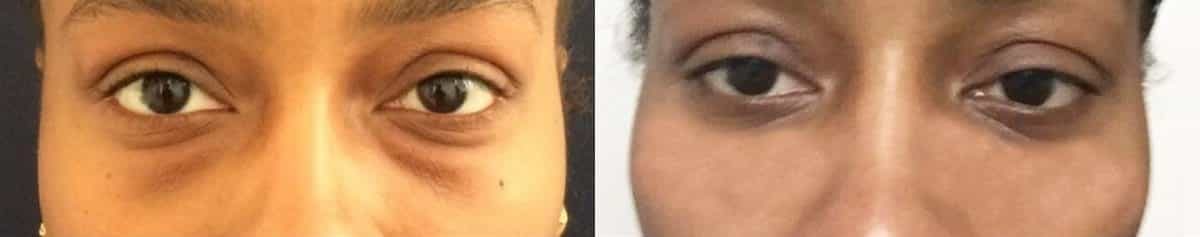 before and after results of female eyelid surgery