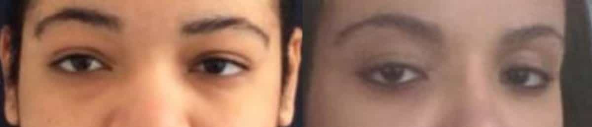 before and after comparison of a patients eyes showing the results of eyelid surgery