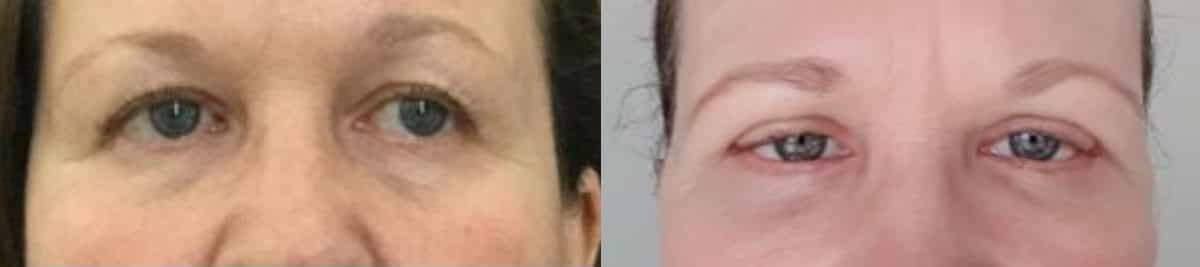before and after blepharoplasty for middle aged woman