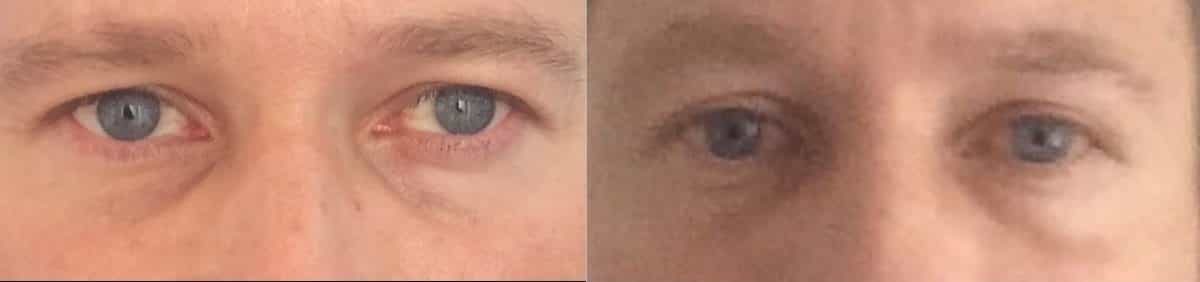 before and after photos showing the results of eyelid surgery on a mans eyes.