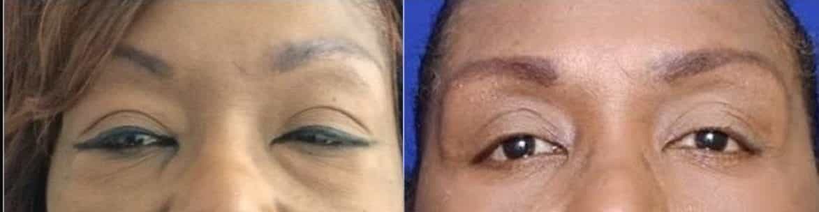 woman before and after blepharoplasty eyelid surgery at premium care plastic surgery