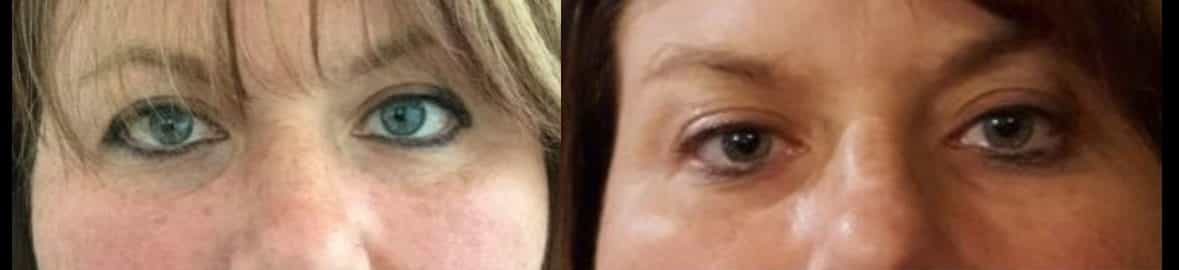 side by side comparison of a womans eyes before and after eyelid surgery