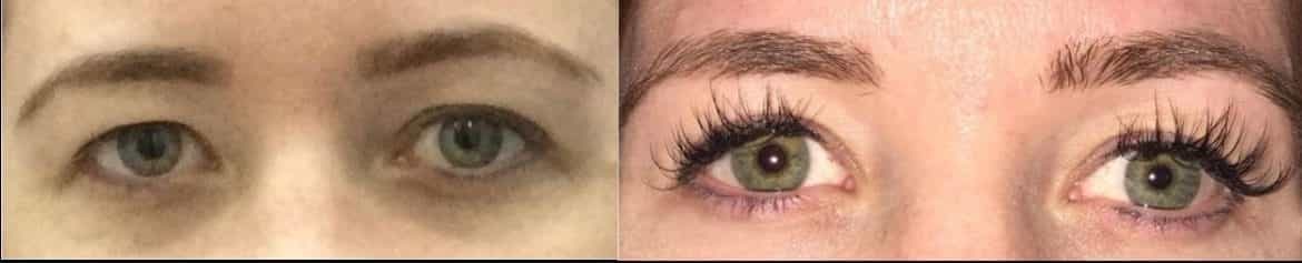 before and after photos highlighting the transformation from eyelid surgery on a womans eyes