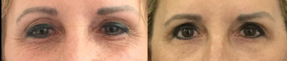 before and after upper eyelid surgery to reduce wrinkles