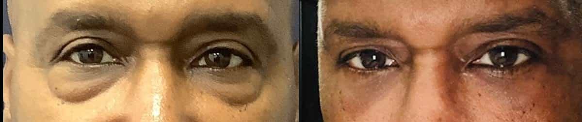 before and after male eyelid surgery blepharoplasty