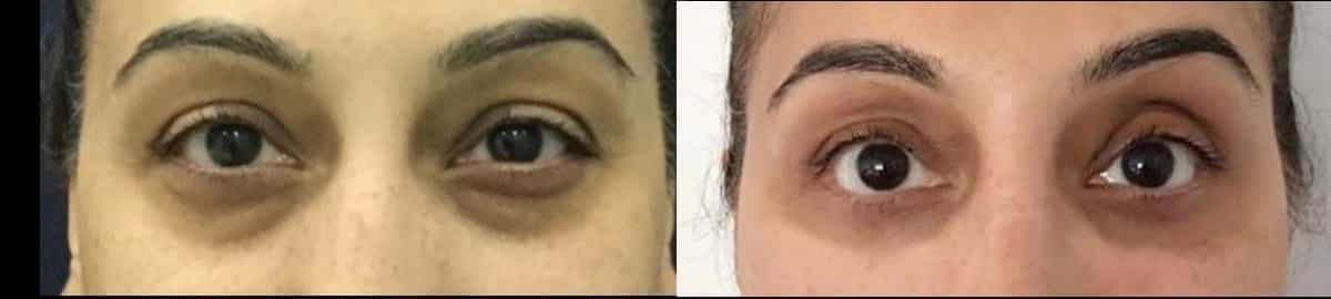 before and after lower eyelid surgery for dark circles removal at premium care