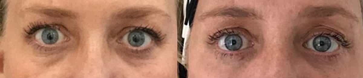 comparison showing before and after eyelid surgery results on a patients eyes