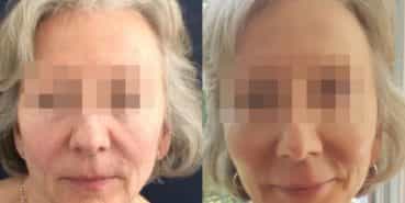 facelift colombia 208 - 1-min