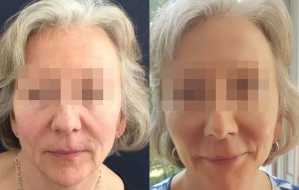 facelift colombia 208 - 1-min