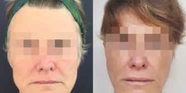 facelift colombia 226 - 1-min