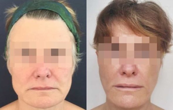 facelift colombia 226 - 1-min