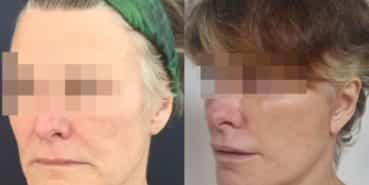 facelift colombia 226 - 2-min