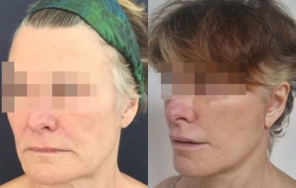 facelift colombia 226 - 2-min