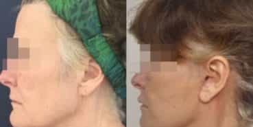 facelift colombia 226 - 3-min