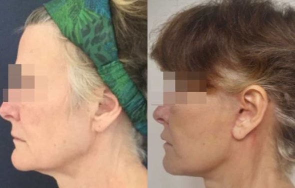 facelift colombia 226 - 3-min