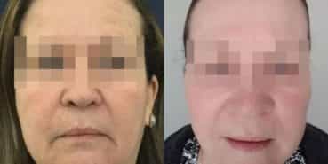 facelift colombia 230 - 1-min