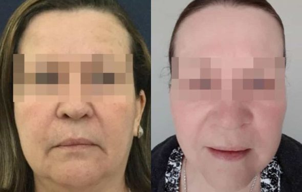 facelift colombia 230 - 1-min