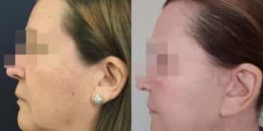 facelift colombia 230 - 2-min