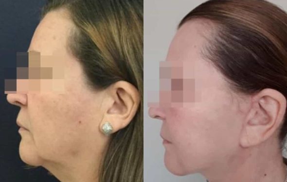 facelift colombia 230 - 2-min