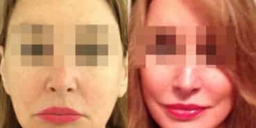 facelift colombia 236 - 1-min