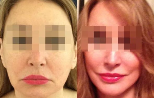 facelift colombia 236 - 1-min