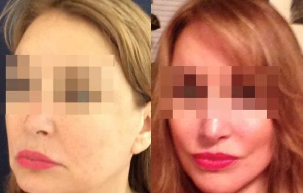 facelift colombia 236 - 2-min