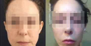 facelift colombia 240 - 1-min