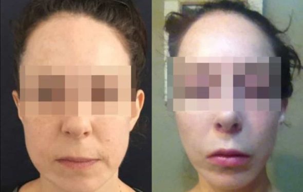 facelift colombia 240 - 1-min