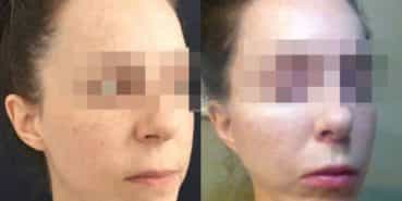 facelift colombia 240 - 4-min
