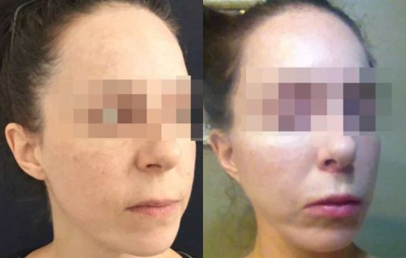 facelift colombia 240 - 4-min