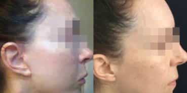 facelift colombia 240 - 5-min