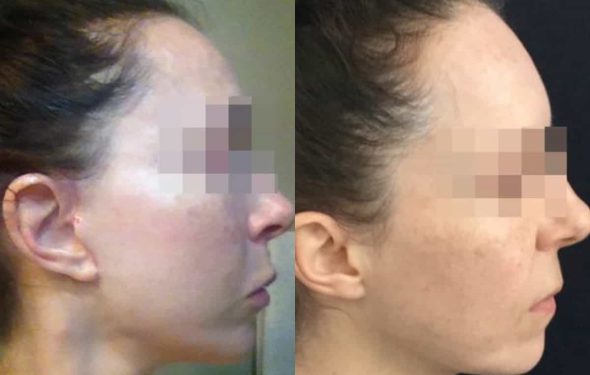 facelift colombia 240 - 5-min