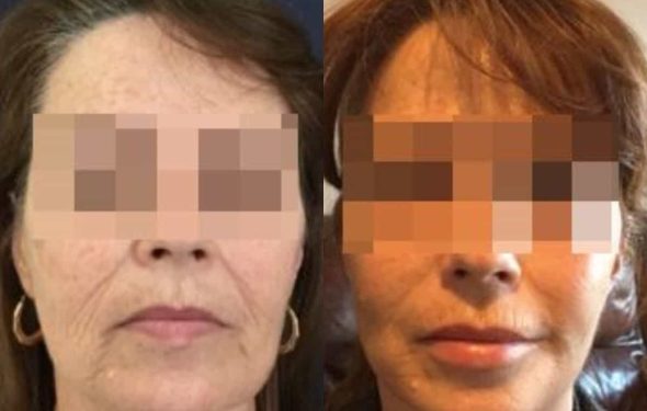 facelift colombia 292 - 1-min