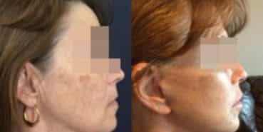 facelift colombia 292 - 3-min