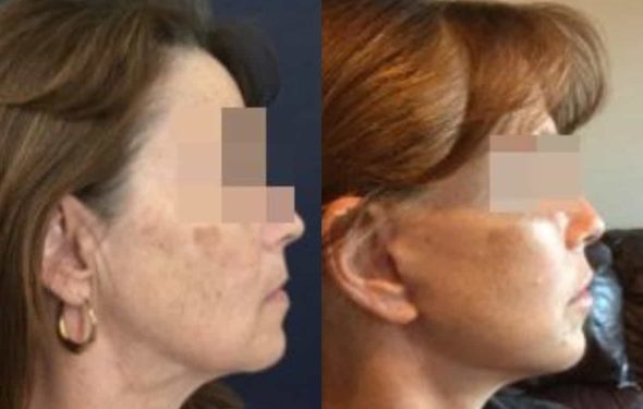 facelift colombia 292 - 3-min