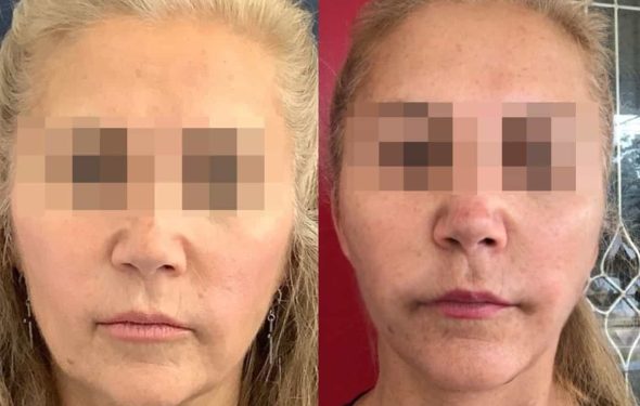 facelift colombia 320 - 1-min