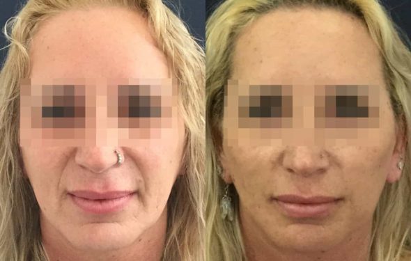 facelift colombia 325 - 1-min