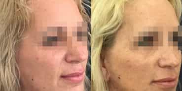 facelift colombia 325 - 2-min