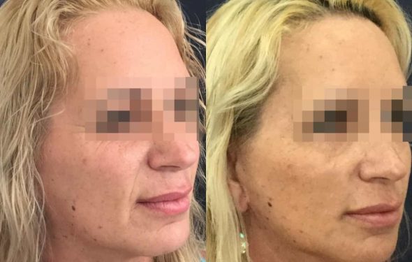 facelift colombia 325 - 2-min