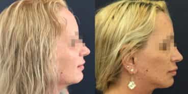 facelift colombia 325 - 3-min