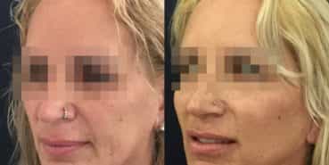 facelift colombia 325 - 4-min