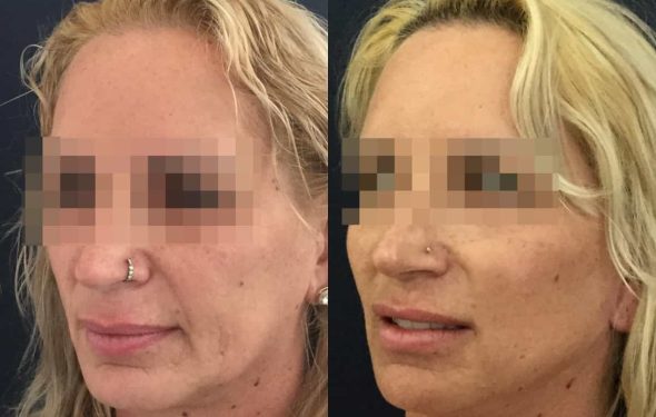 facelift colombia 325 - 4-min