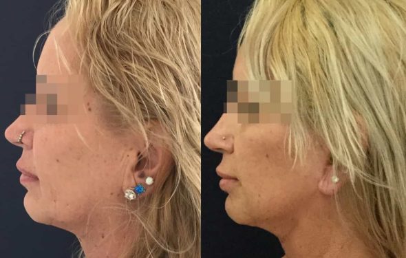 facelift colombia 325 - 5-min