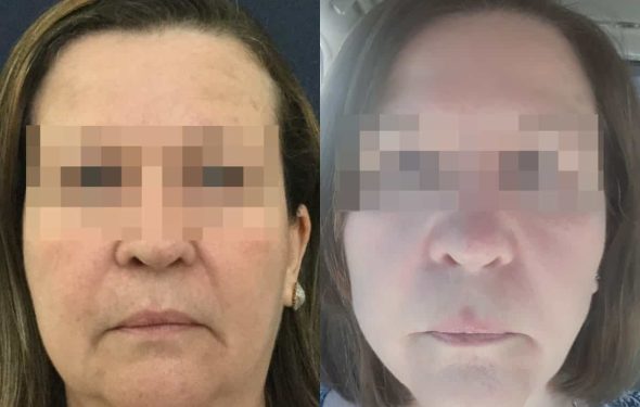 facelift colombia 329 - 1-min