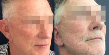facelift colombia 352 - 2-min