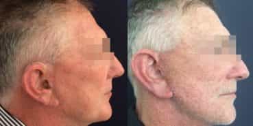 facelift colombia 352 - 3-min
