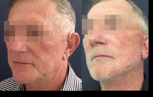 facelift colombia 352 - 4-min